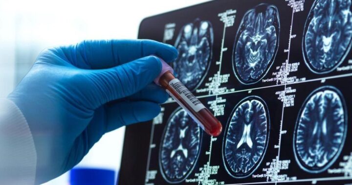 Alzheimer: Cuatro descubrimientos que transforman el diagnóstico y tratamiento en 2026