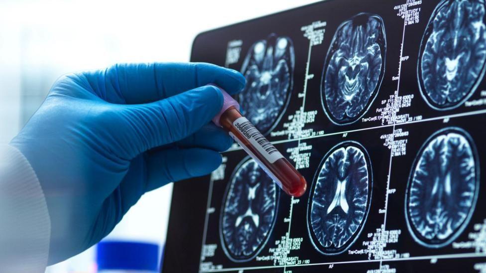 Alzheimer: Cuatro descubrimientos que transforman el diagnóstico y tratamiento en 2026