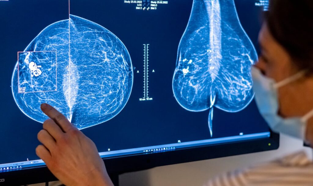 El cribado con ayuda de la IA mejora la detección temprana del cáncer de mama | Salud y bienestar