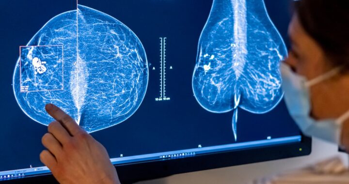 El cribado con ayuda de la IA mejora la detección temprana del cáncer de mama | Salud y bienestar