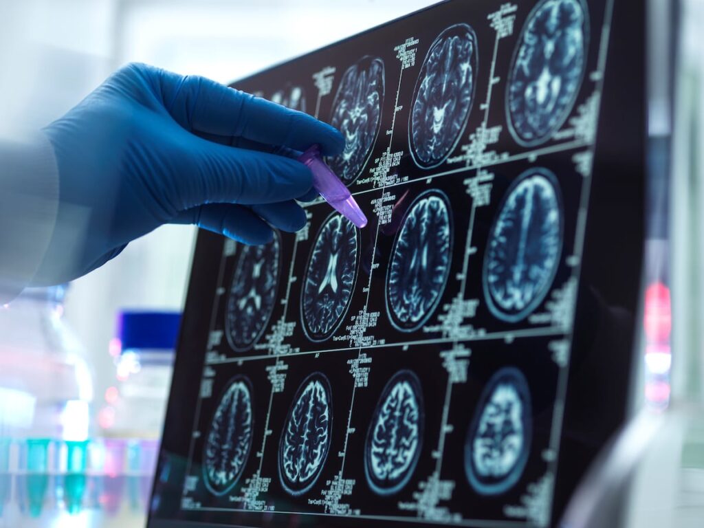 Un nuevo análisis permite detectar el alzhéimer a partir de un pinchazo en el dedo | Ciencia