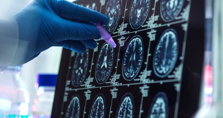 Un nuevo análisis permite detectar el alzhéimer a partir de un pinchazo en el dedo | Ciencia