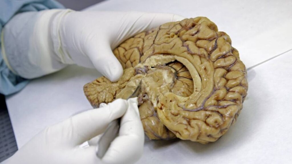 El hallazgo de una red cerebral que conecta cuerpo y mente apunta hacia mejores tratamientos contra el párkinson | Ciencia