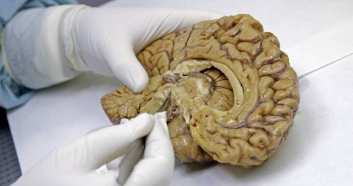 El hallazgo de una red cerebral que conecta cuerpo y mente apunta hacia mejores tratamientos contra el párkinson | Ciencia