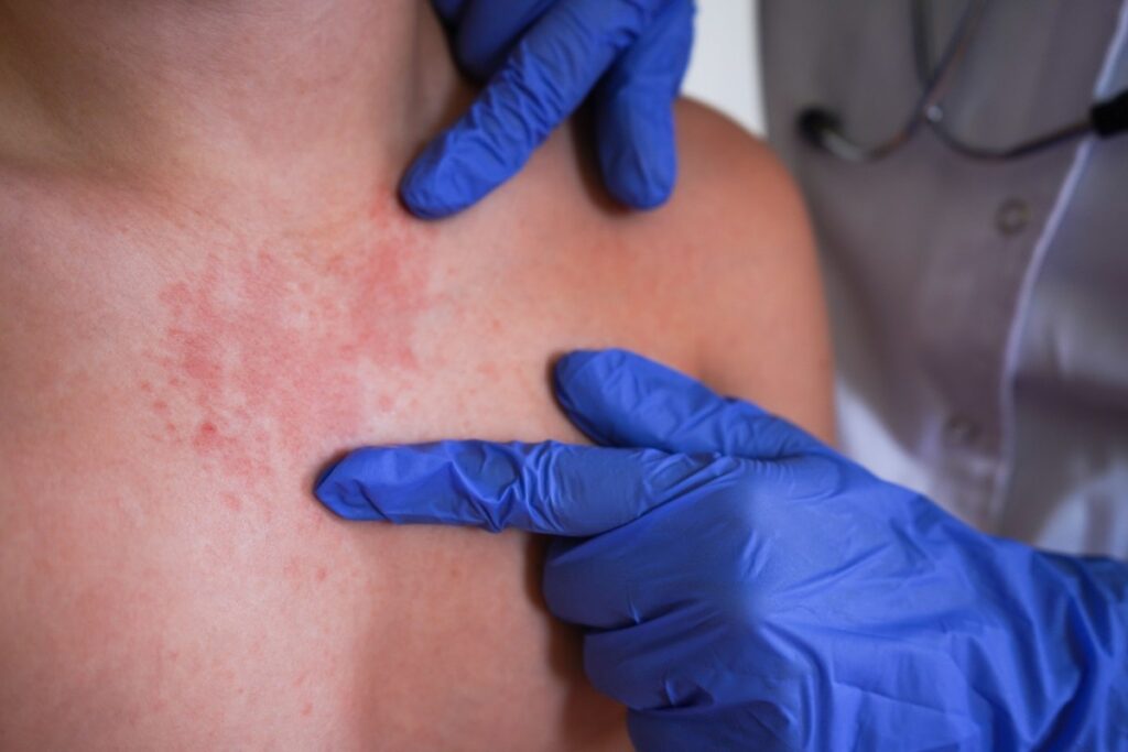 Alerta por sarampión en Norteamérica: México lidera contagios y EE.UU. refuerza vigilancia sanitaria