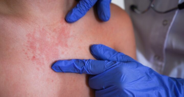 Alerta por sarampión en Norteamérica: México lidera contagios y EE.UU. refuerza vigilancia sanitaria