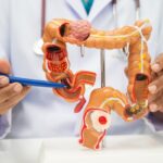 Cáncer de colon: 5 síntomas que se confunden con una colitis