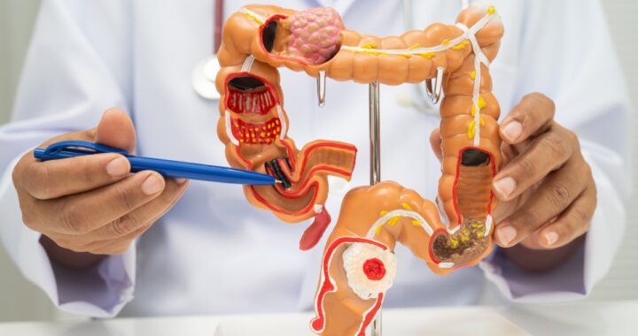Cáncer de colon: 5 síntomas que se confunden con una colitis